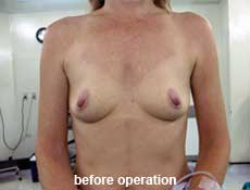 plastic-surgery-breast-augmentation 